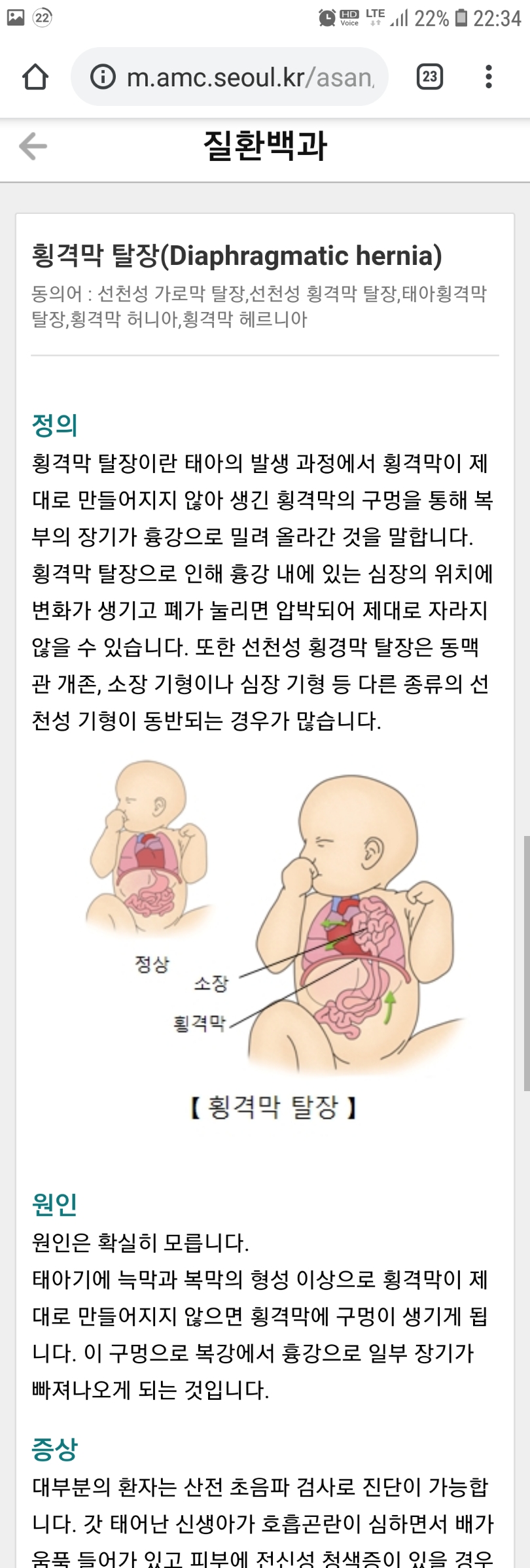 Screenshot_20190604-223431_Chrome.jpg : 횡격막 탈장 ㄷㄷㄷㄷ Screenshot_20190604-223431_Chrome.jpg : 횡격막 탈장 ㄷㄷㄷㄷ
